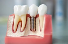 Что входит в понятие имплантация зубов под ключ?