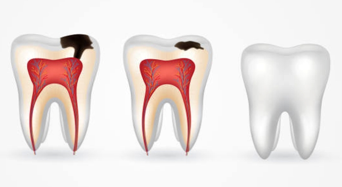 Как производится лечение кариеса зубов?