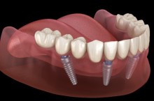 Как восстановить утраченный зубной ряд?
